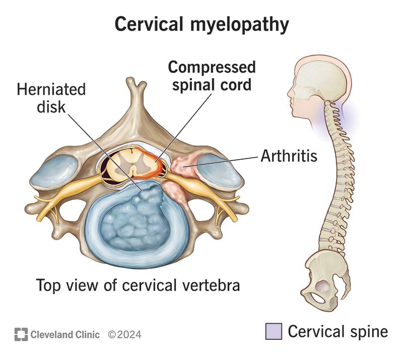 Cervical myelopathy, with a herniated disk and compressed spinal cord