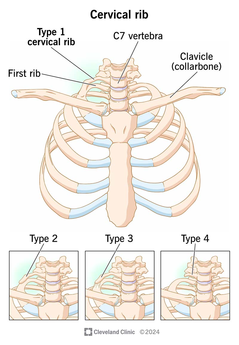 A cervical rib is an extra bone in your neck. There are four different types of this rare bone that you can have at birth