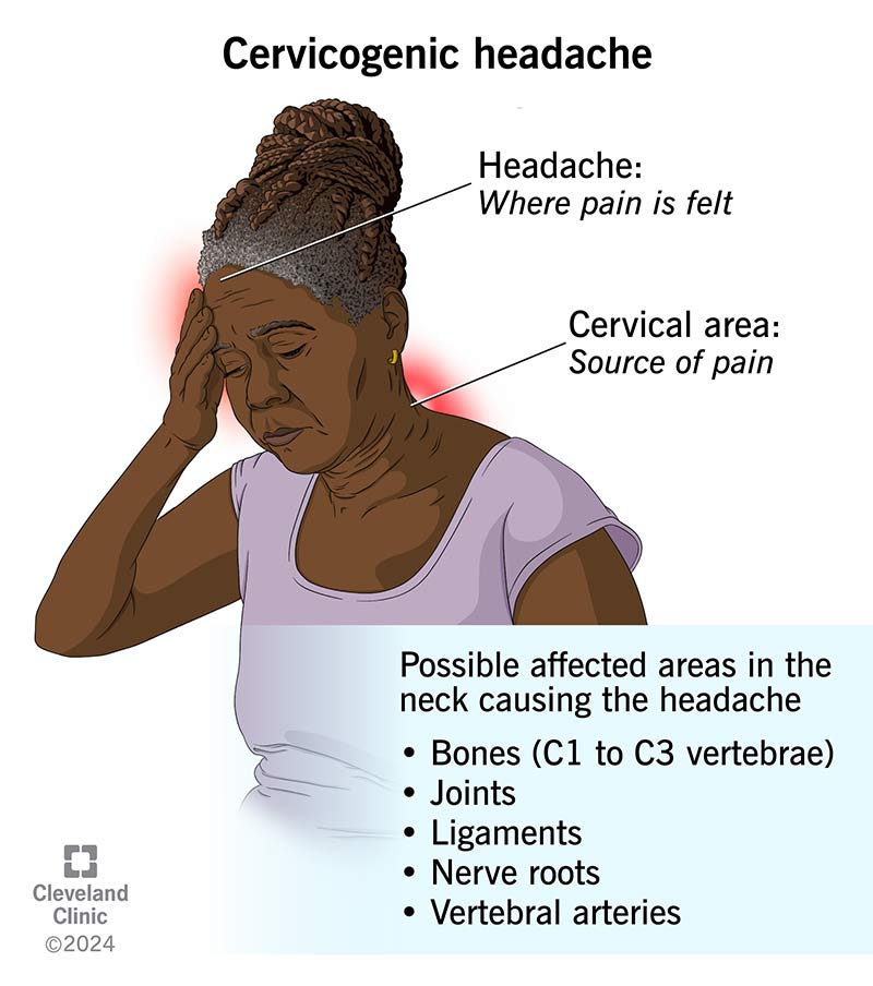 The location of a cervicogenic headache and possible causes of the pain.