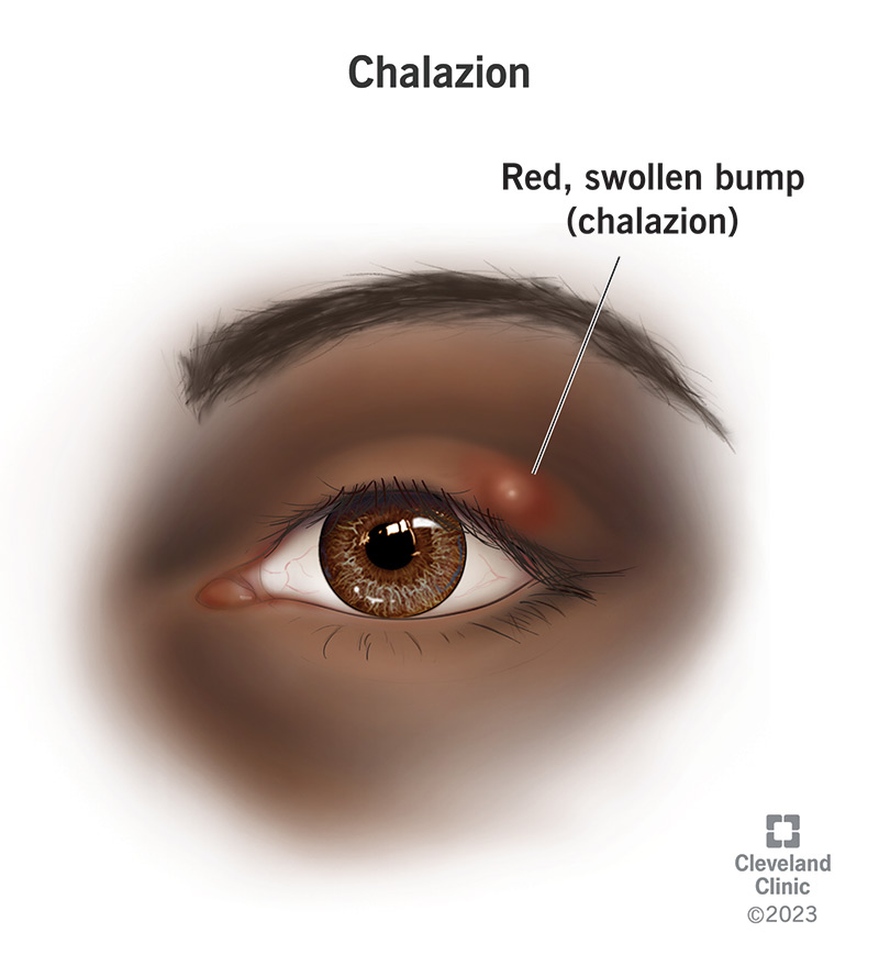 A chalazion forming on the underside of a person’s upper eyelid