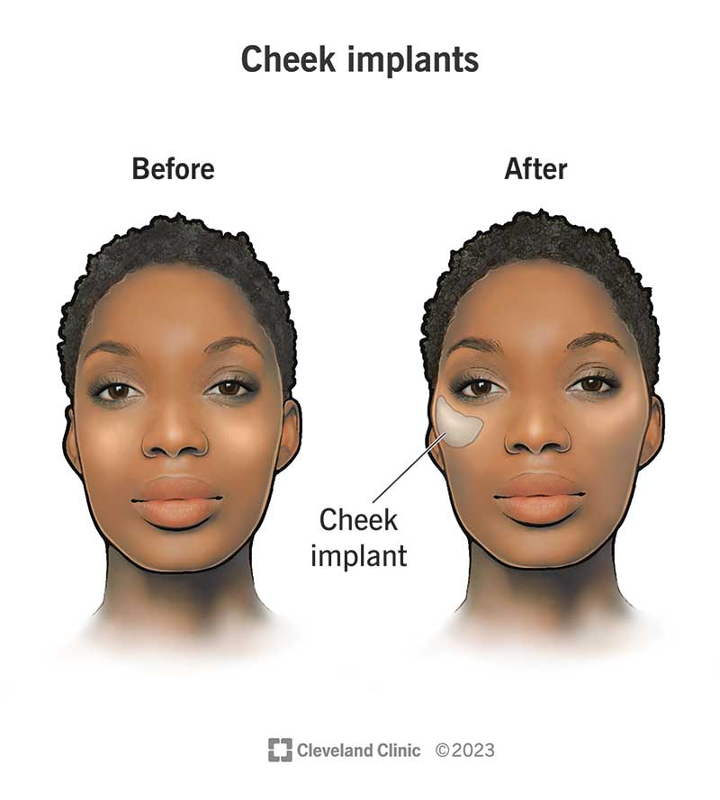 An illustration of a person’s face before and after cheek implants.