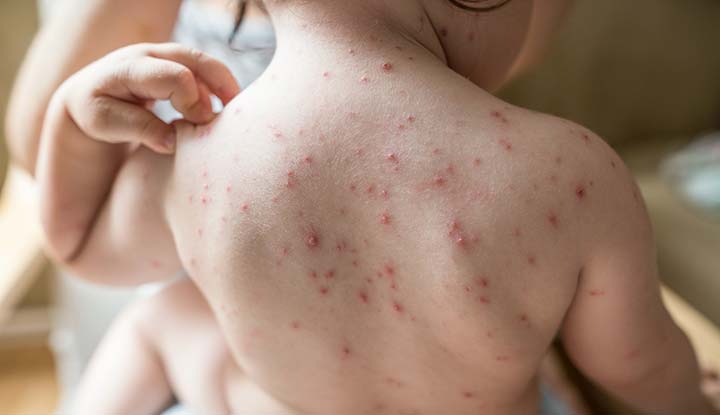 Chickenpox is a contagious virus that causes an extremely itchy rash.