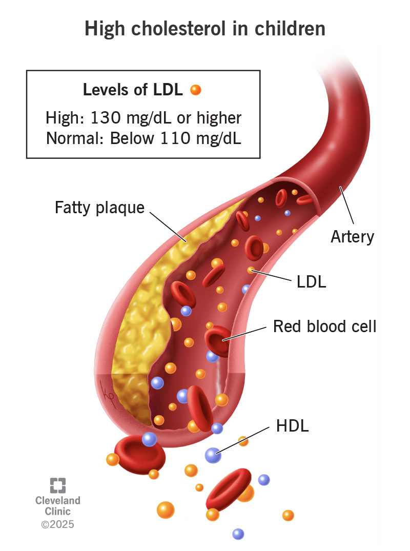 In children, LDL cholesterol should be below 110, and 130 or above is considered high.