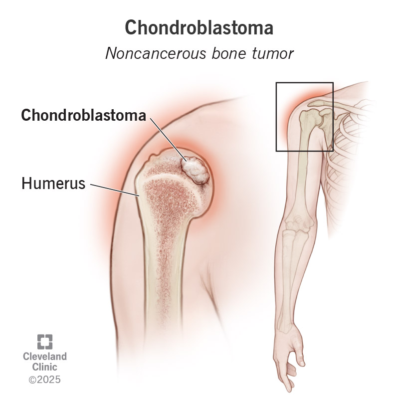 Chondroblastoma, with a noncancerous tumor on the humerus bone