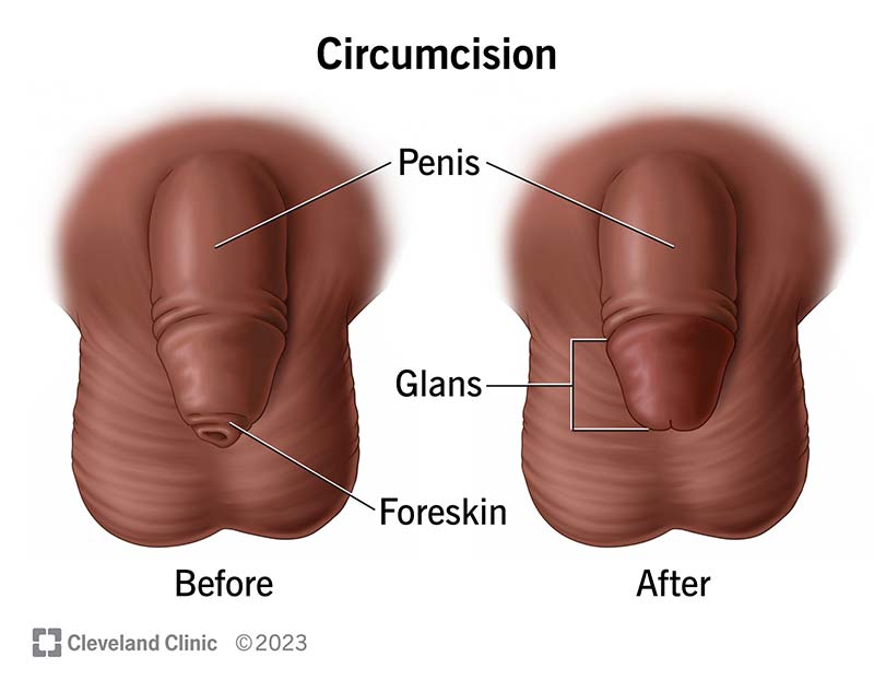 Circumcision surgically removes the foreskin to expose the glans, or tip of the penis