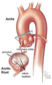 Aortarotaneurisme