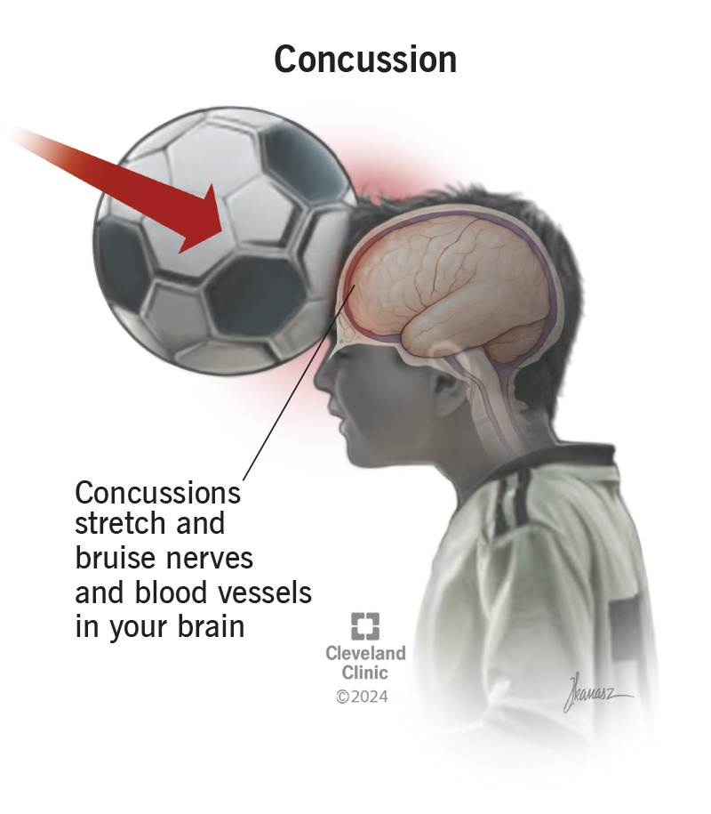 Concussions stretch and injure blood vessels in your brain.