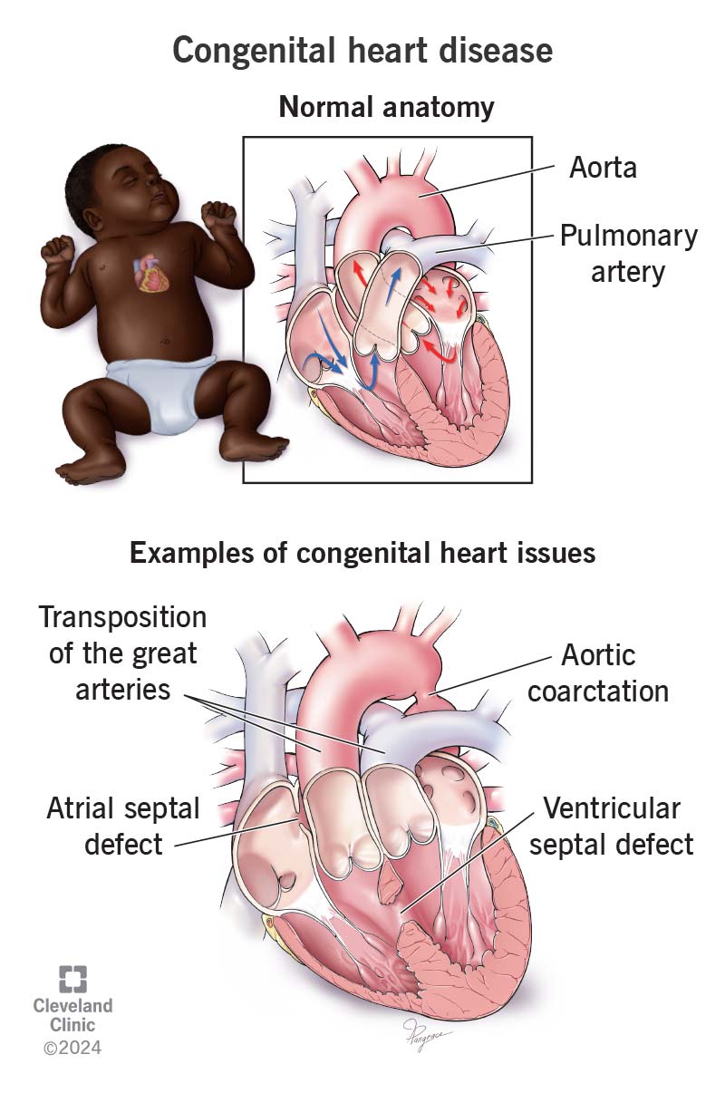 Comparing a normal heart to one with congenital heart disease shows issues that exist at birth