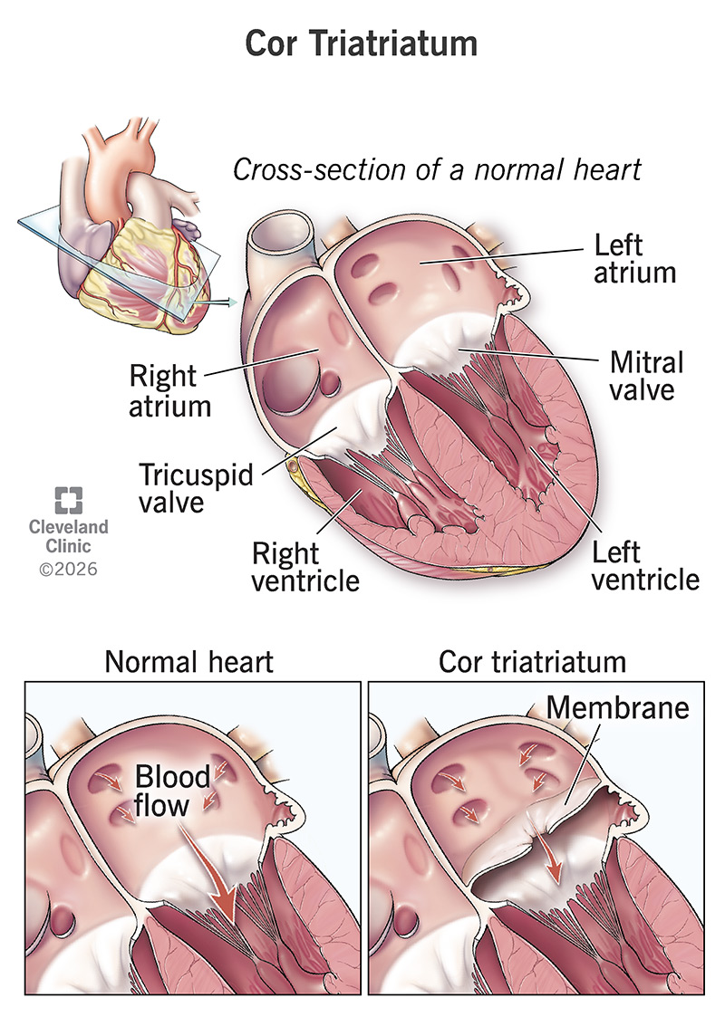 Normal heart anatomy with two top chambers (atria) versus cor triatriatum with a divided top chamber