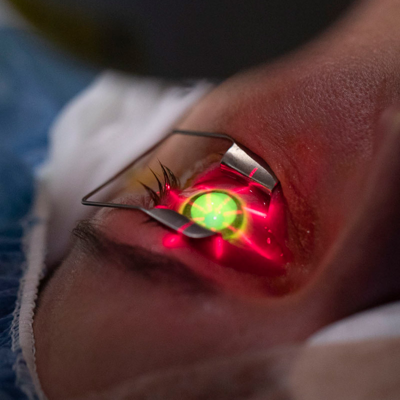 Corneal cross-linking procedure, using UV light to stimulate collagen bonds in a cornea