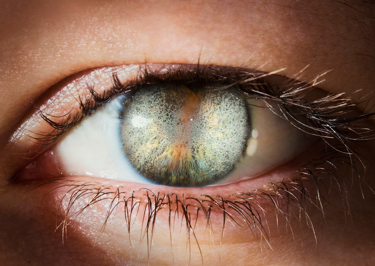 An eye with corneal dystrophy, disrupting the tissue layers of the cornea