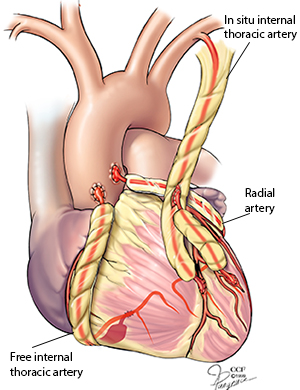 Coronary Artery Bypass Surgery Procedure Details Cleveland Clinic