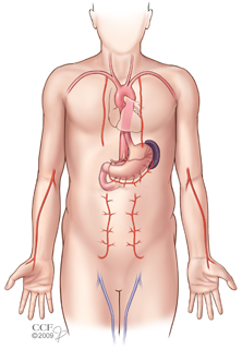 Injertos de derivación arterial coronaria - Ubicaciones