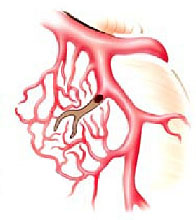 Collateral circulation around a blood clot.