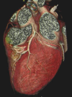 Coronary Computed Tomography Angiogram