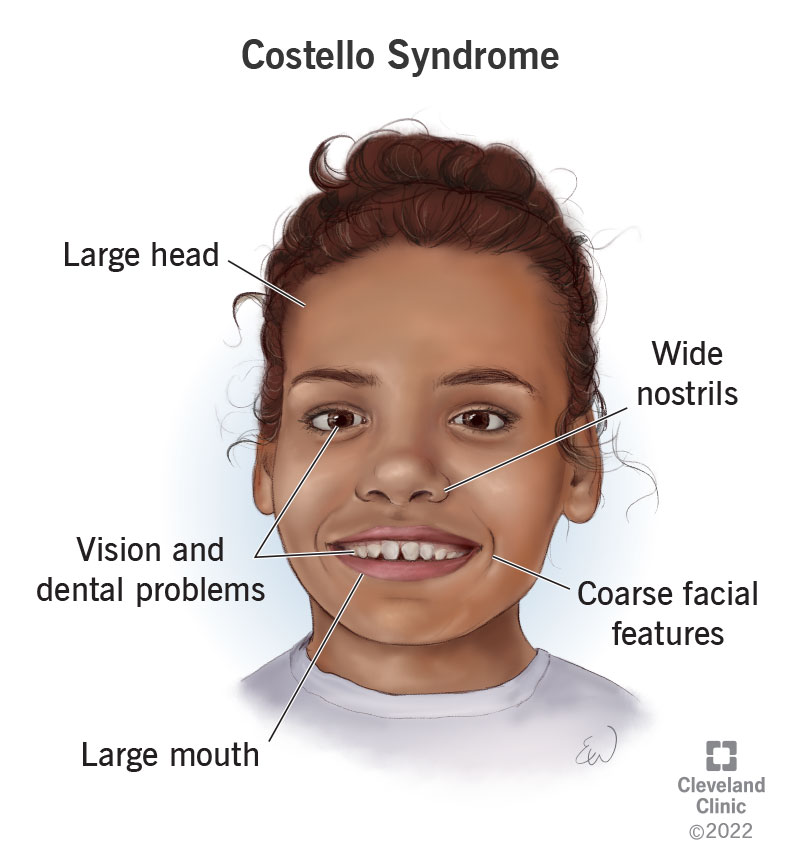 Facial characteristics and symptoms of a child with Costello syndrome.