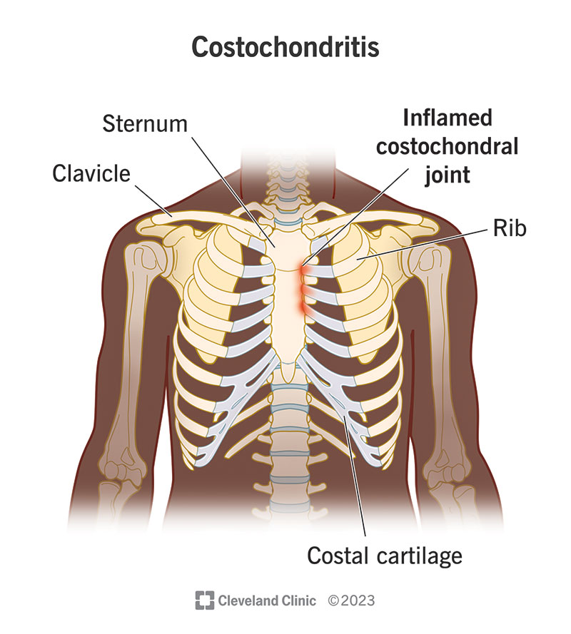 Costochondritis is painful inflammation in the cartilage that connects your ribs to your sternum (breastbone).
