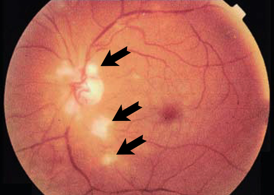 A retinal image with arrows pointing to cotton wool spots