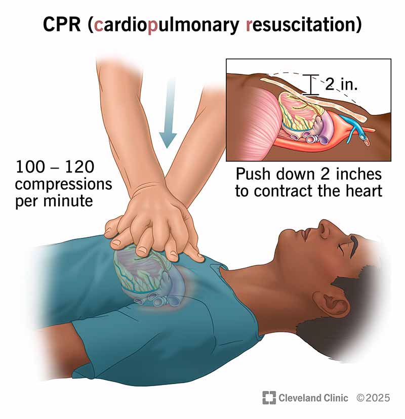 Push down on the person’s chest 2 inches deep for chest compressions 100 to 120 times per minute