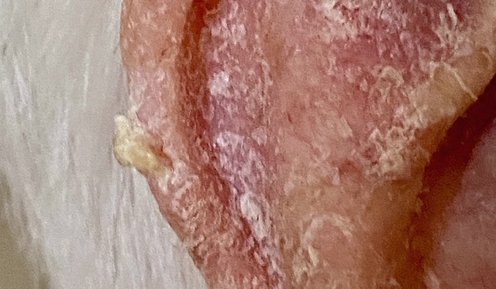 A cutaneous horn (a hard cone-shaped growth) on the outer edge of an ear