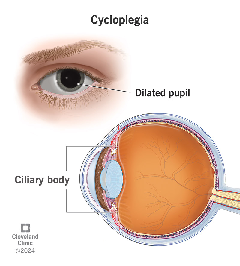 Cycloplegia temporarily paralyzes the iris and ciliary bodies, dilating your pupils and preventing focusing on near objects