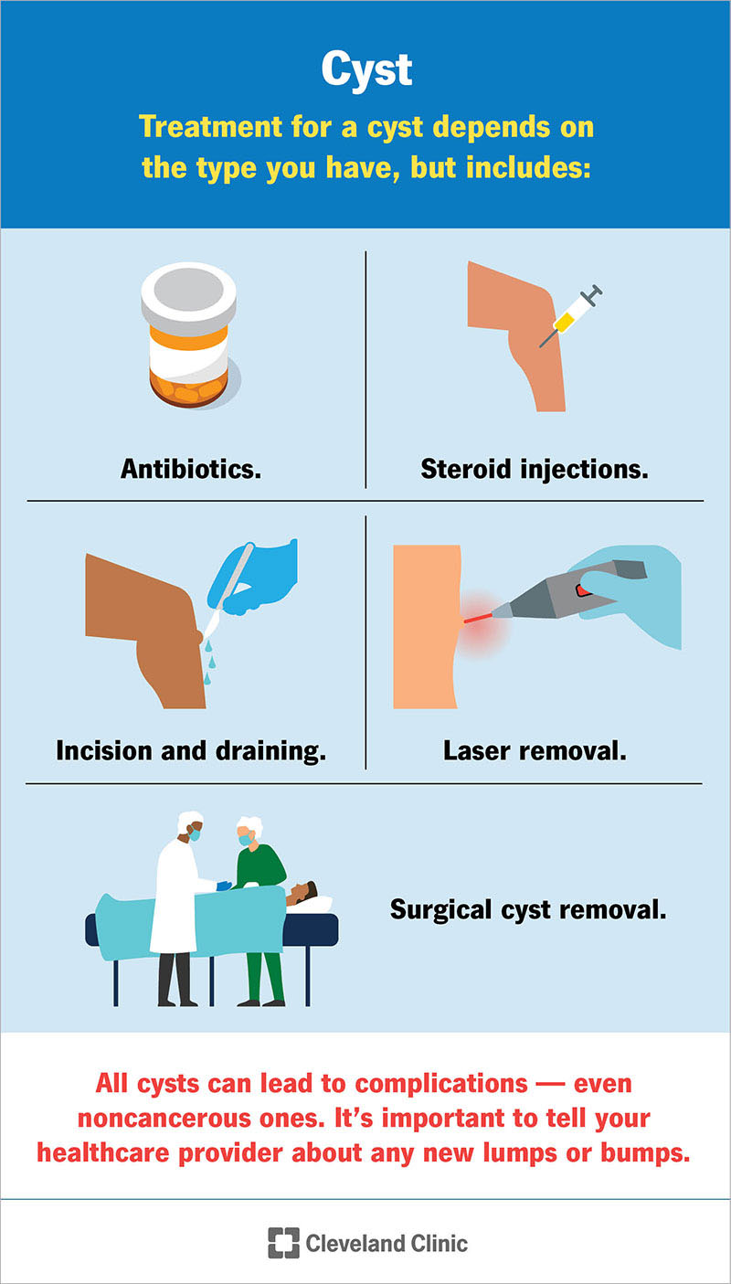 What Is A Sister Cyst