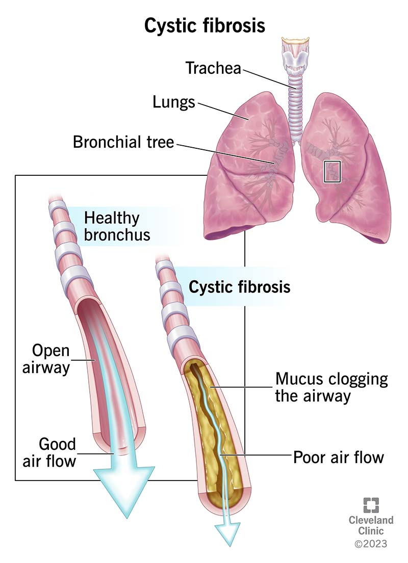 Image of healthy bronchus in the lungs and one with cystic fibrosis. The thick mucus in someone with CF limits air flow.