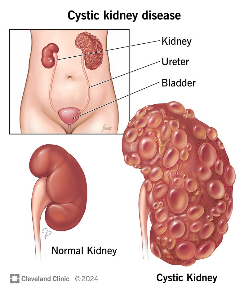 Cystic kidney disease causes cysts to grow on your kidneys. Cysts can affect kidney function if there are many, or they grow