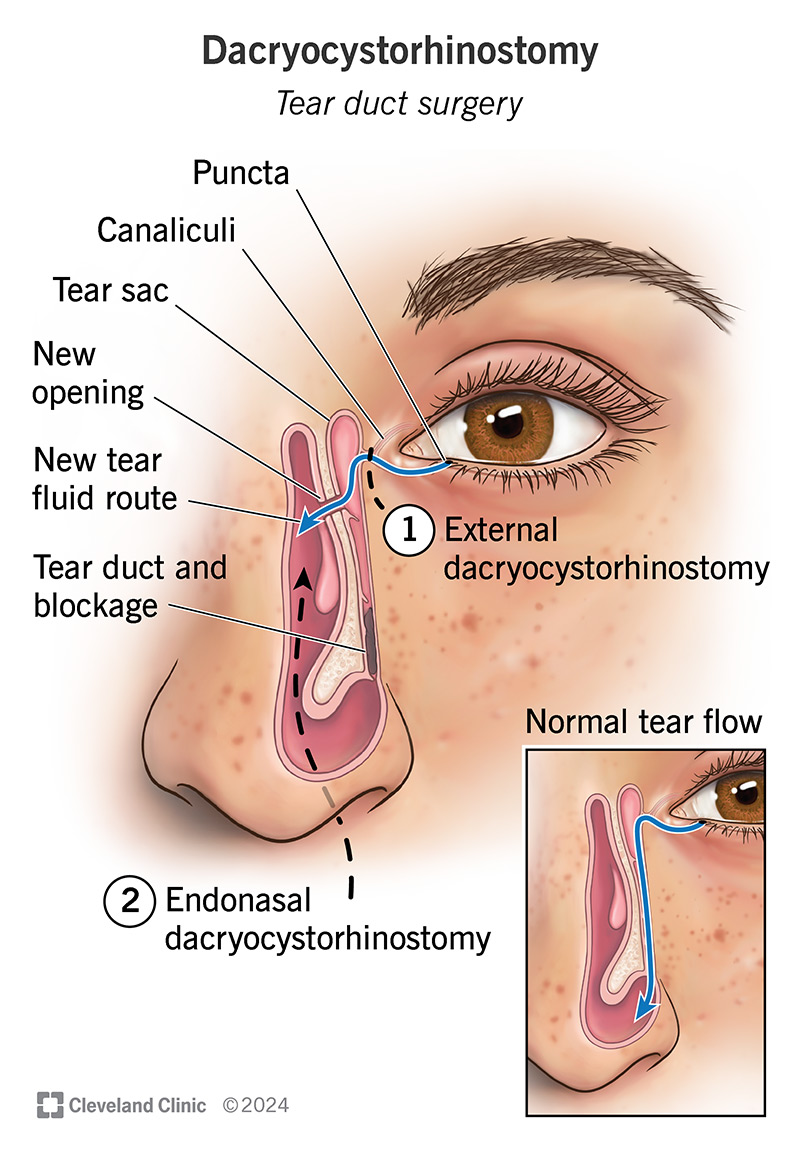 Tear duct surgery can be external, done through an incision on your face, or endonasal, done from inside your nose