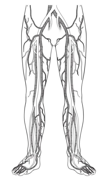 Deep Vein Thrombosis (DVT); Symptoms, Causes, Treatment ...