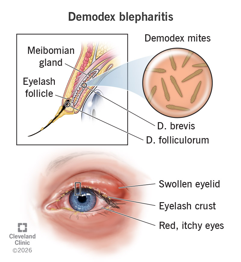 Anatomy of eye with Demodex mites, with related symptoms of swollen eyelid, eyelash crust and red eyes