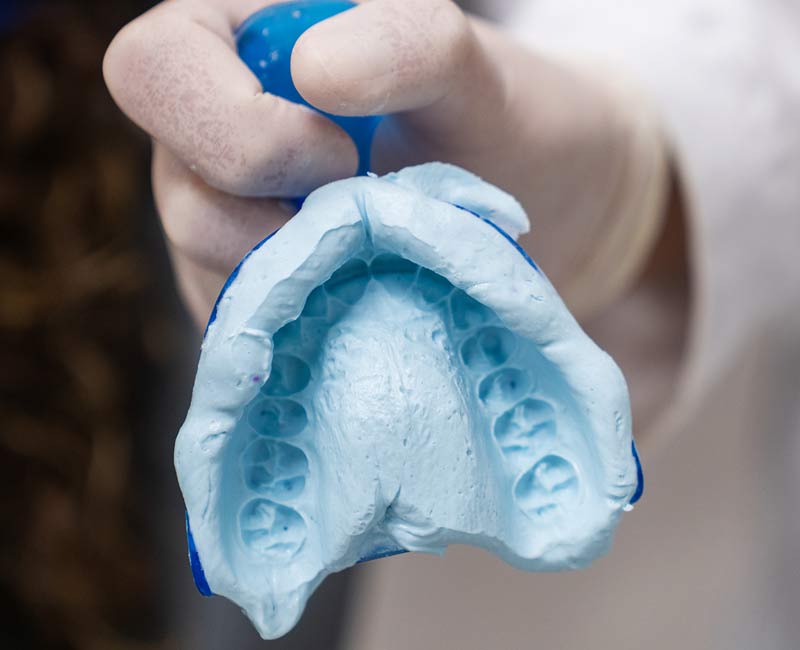 Close-up of a blue dental impression showing upper teeth and palatal (roof of the mouth) details
