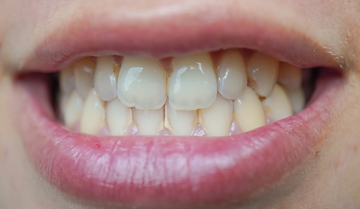 Upper and lower teeth, with slight dental plaque buildup between certain teeth