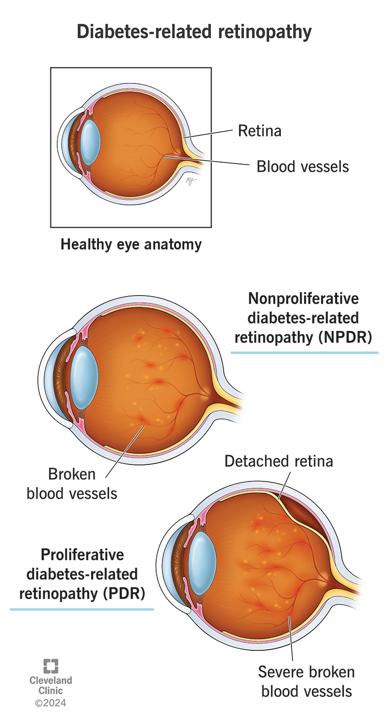 Both the proliferative and nonproliferative subtypes of diabetes-related retinopathy involve damage to your retina.