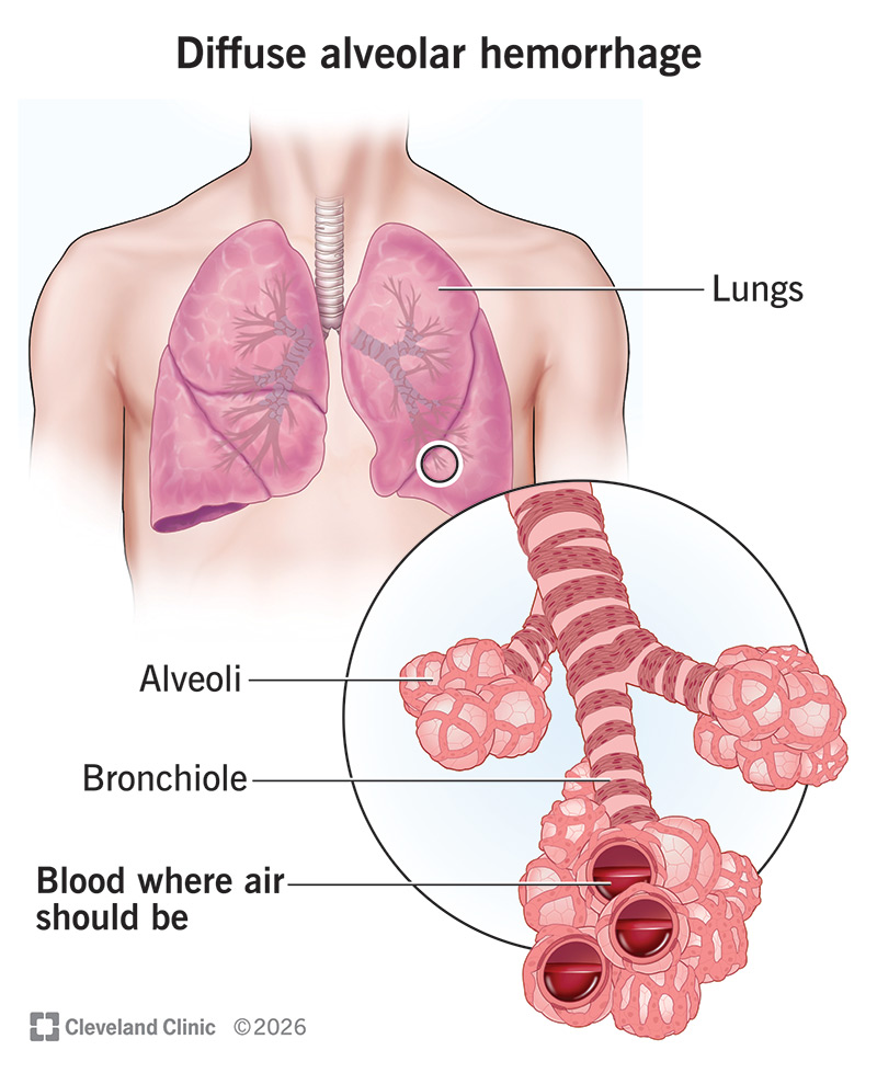Lung anatomy with bronchiole and alveoli, and blood in the small sacs where air should be