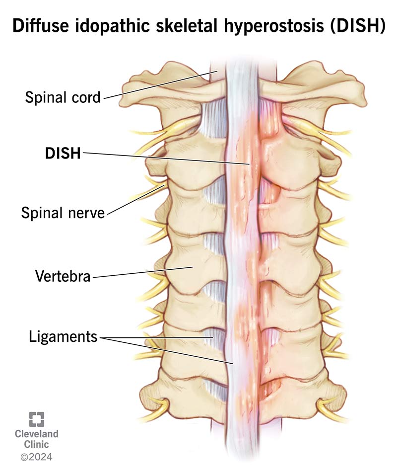 Diffuse idiopathic skeletal hyperostosis causes bone tissue to overgrow into your soft tissues, usually along your spine.