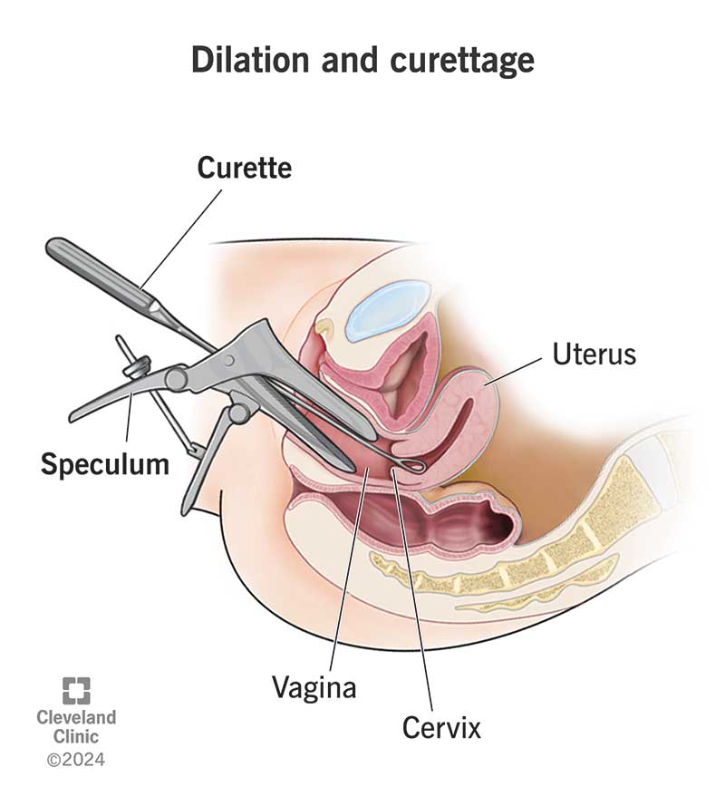 Anatomy of a dilation and curettage procedure (D&C), with a speculum and curette, and vagina, cervix and uterus