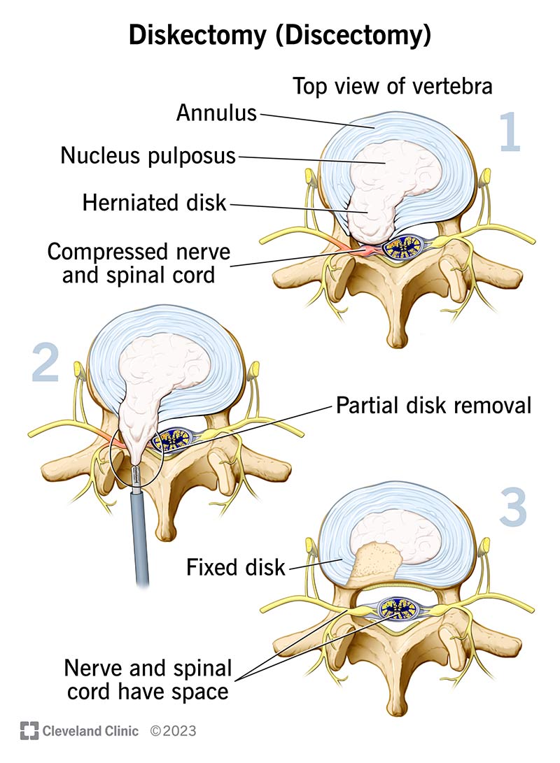 Illustration of the anatomy of a vertebra and disk. It shows a herniated disk and a partial disk removal.