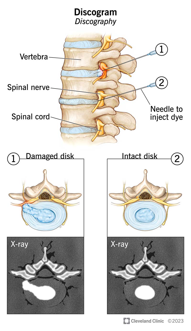 A discogram helps providers tell the difference between a damaged disk and an intact disk.