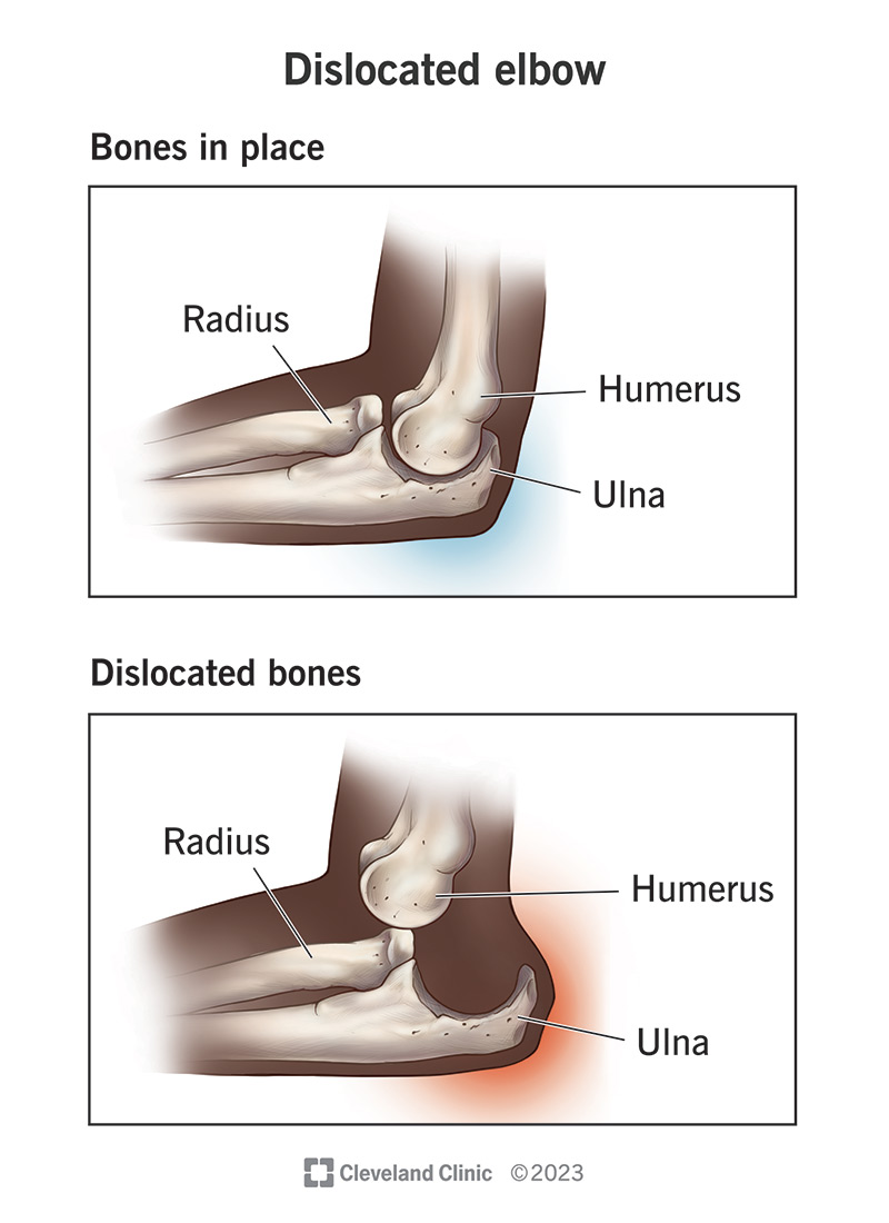 Dislocations happen when the bones in a joint are pushed or moved out of place.