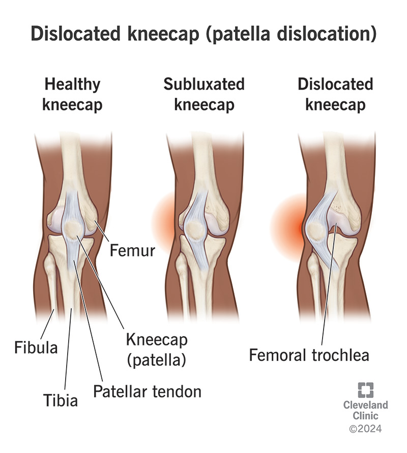 A healthy kneecap, subluxated kneecap and dislocated kneecap (patella dislocation)