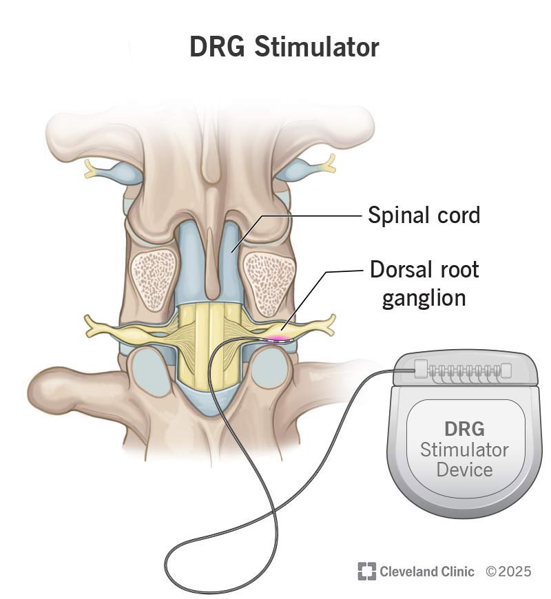 A DRG stimulator device, with the spinal cord and dorsal root ganglion