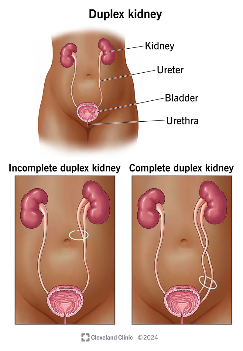 Image shows incomplete duplex kidney or two ureters joining before the bladder, and duplex kidney, two separate ureters.