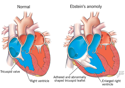 Ebstein's anomalie-vergelijking