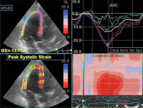 Echokardiogramm mit Strain Imaging