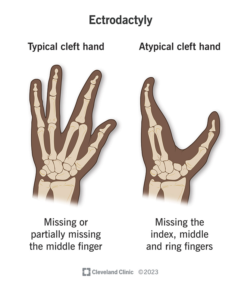 Illustration comparing typical cleft hand ectrodactyly and atypical cleft hand ectrodactyly.