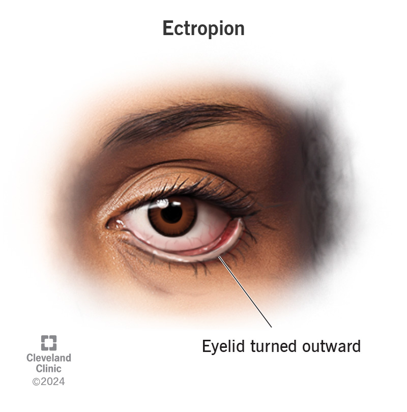 Female with ectropion (eyelid turns outward)