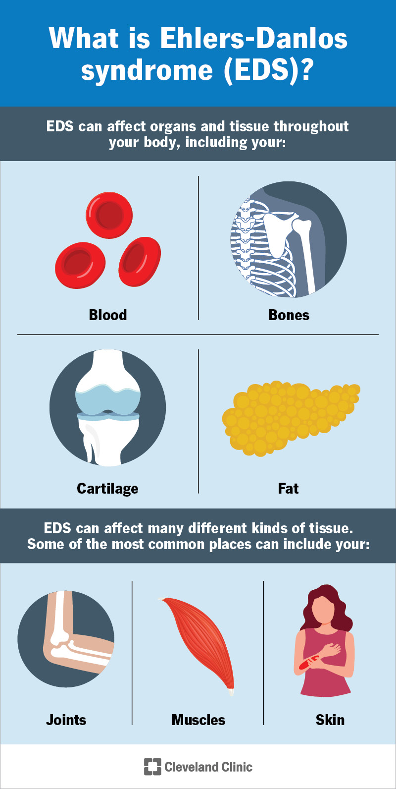Ehlers-Danlos syndrome can affect lots of tissue and cause many symptoms.