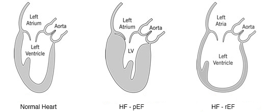 Ejection Fraction Age Chart