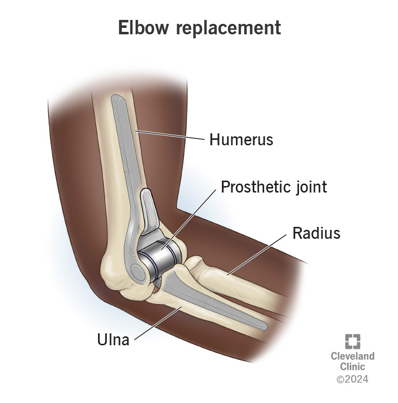 Prosthetic elbows are artificial joints made of metal and plastic.